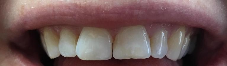  Chipped Tooth Filler