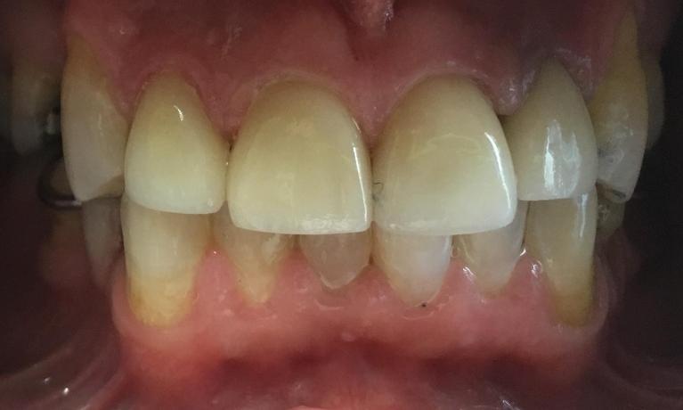 Four-Anterior-Crowns-After-Image