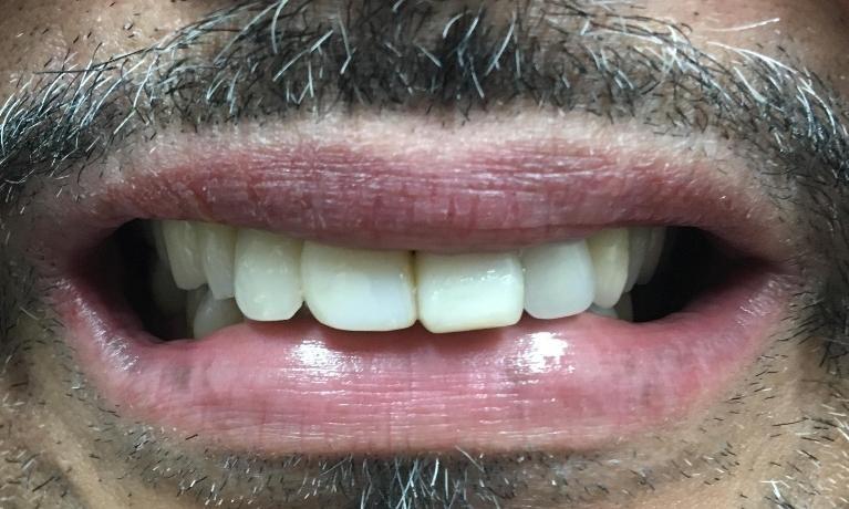 Tooth-Colored-Fillings-After-Image