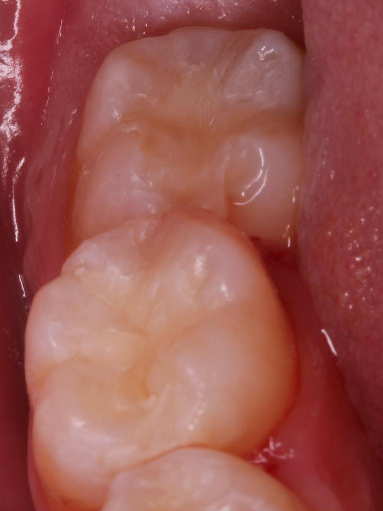 Composite Fillings, Tooth-Colored Fillings, Cosmetic Dentistry Rochester MN