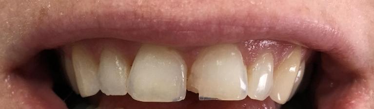 Chipped-Tooth-Before-Image