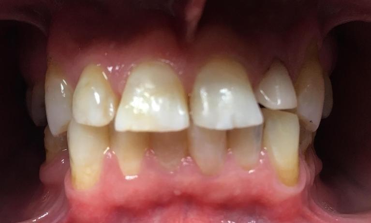 Four-Anterior-Crowns-Before-Image