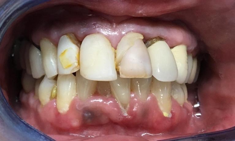 Tooth-Colored-Fillings-Before-Image