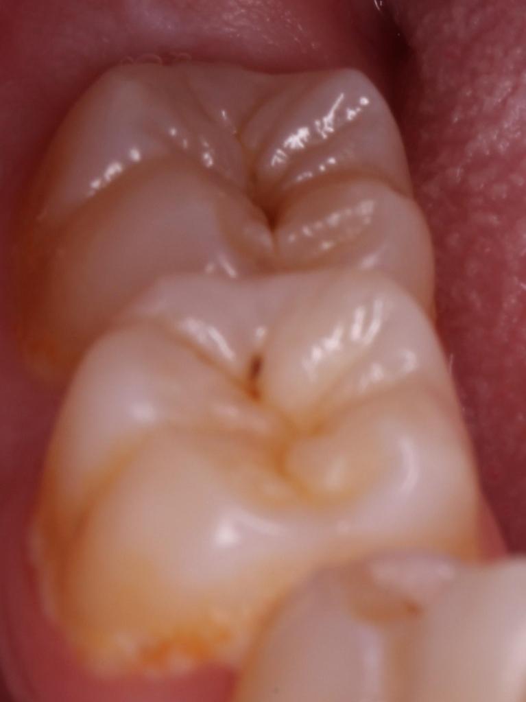 Composite Fillings, Tooth-Colored Fillings, Cosmetic Dentistry Rochester MN