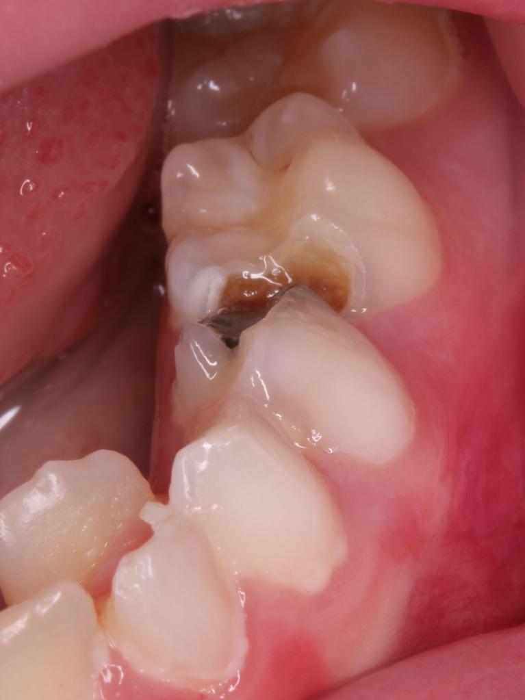 Decay, Dr. Molly Jarrett, Pediatric Dentistry